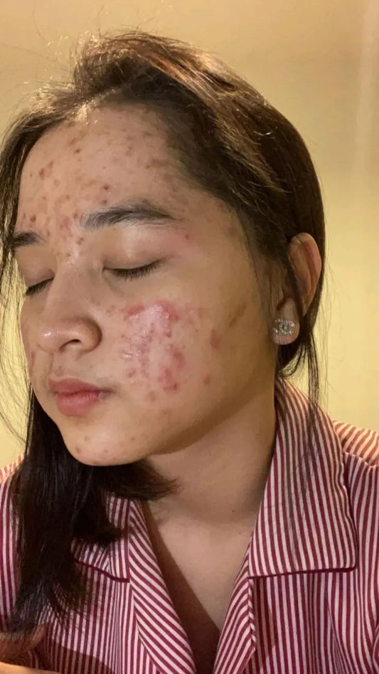 Acné-sécheresse-rougeurs-comment-choisir-les-bons-soins EclatCoréen